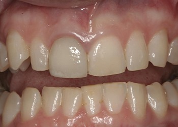 Discolored teeth