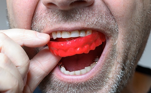 Man placing an athletic mouthguard