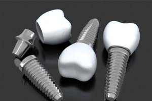 three dental implants with abutments and crowns