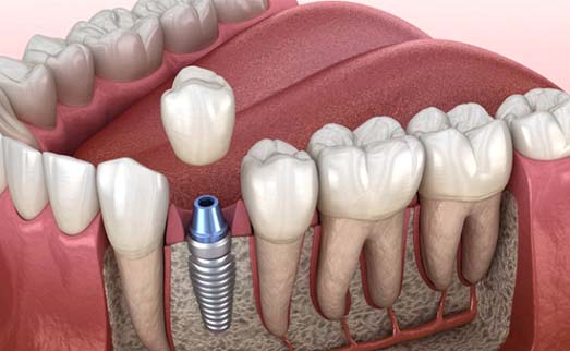 single dental implant with crown in lower arch