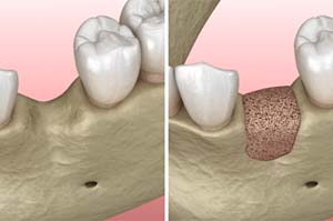 jawbone before and after bone grafting