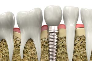 dental implant in jawbone