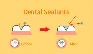 dental sealants illustration 