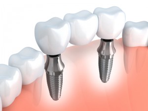 Dr. Thomas Neslund replaces Carlisle missing teeth with excellent options, including dental implants. Learn the whys and hows from this experienced dentist.